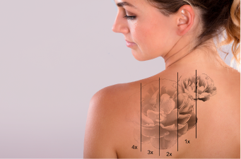 Tratamientos para Eliminar tatuajes